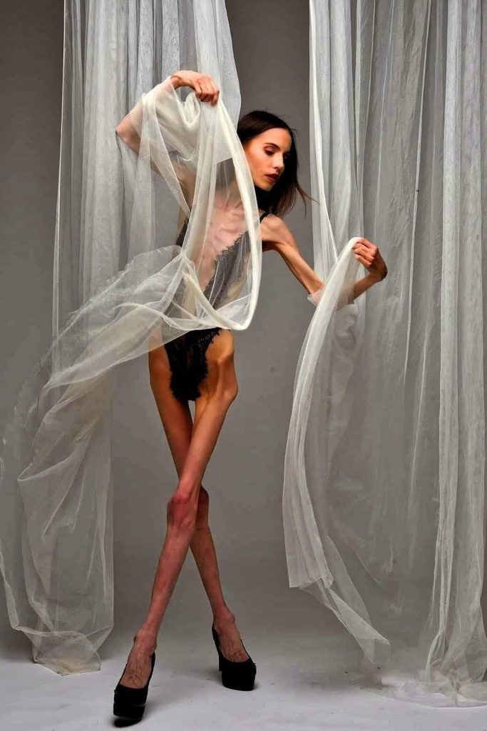 Anorexia reprezinta o boala psihica care determina aparitia tulburarilor alimentare prin deformarea imaginii propriului corp si teama nejustificata de crestere ponderala.