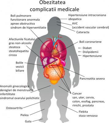 Obezitatea Ce este, Cauze, Complicatii si Tratament
