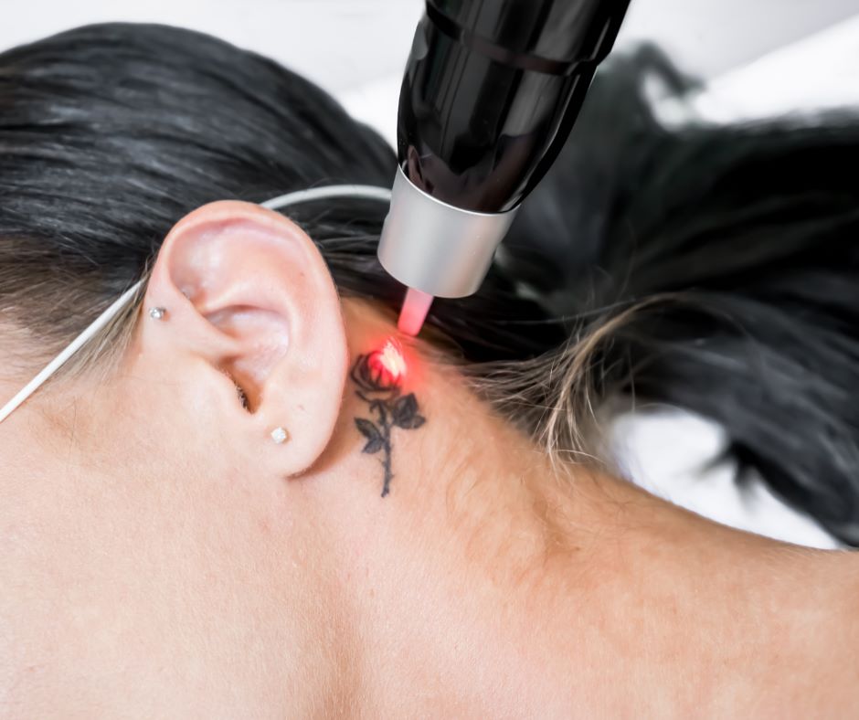indepartare tatuaje cu laser