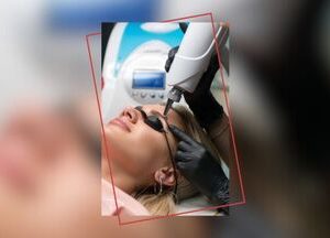indepartare tatuaj laser