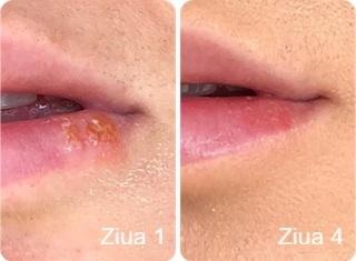Laser pentru zona buzelor la Beauty Lines Iași